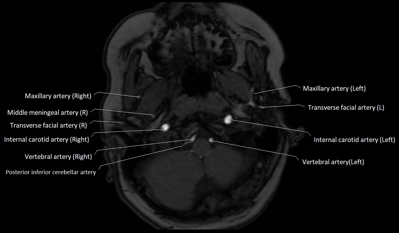 Carotid artery anatomy axial 3T image 2.jpg